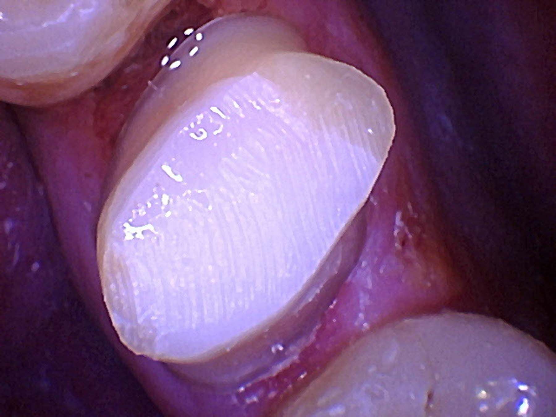 Figure 9.  Upon beginning the crown preparation, I noticed an excellent stain-free, gap-free margin.