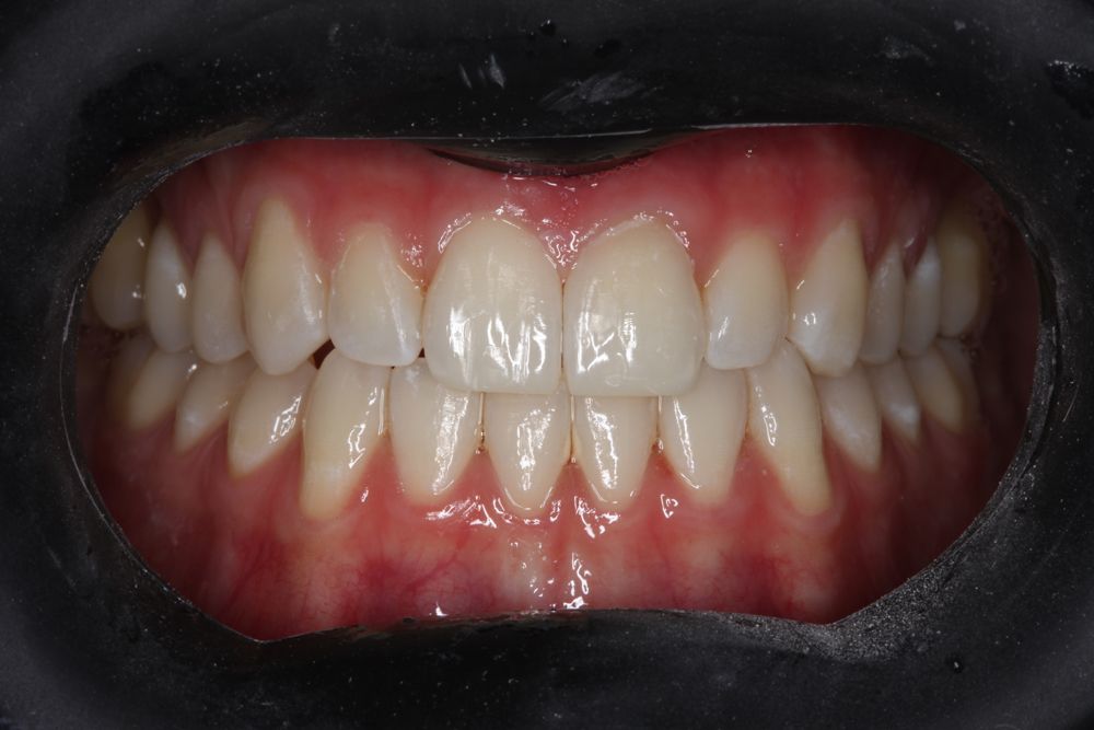 The completed restorations created a beautiful result and were made simple to place by using the Compex HD by AdDent.