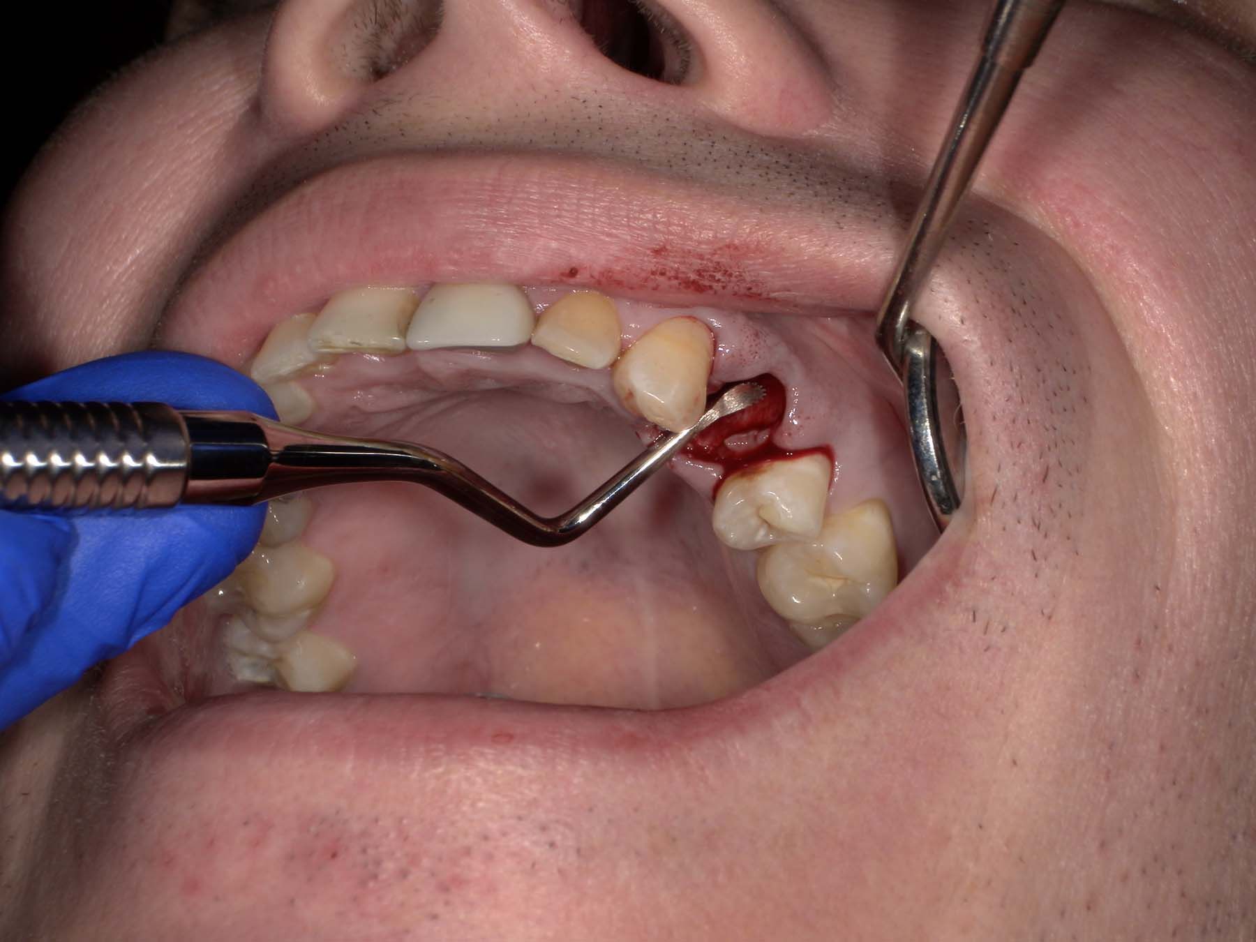 Figure 6. The author reengaged the straight Xpanders and drove them apically until the root popped up enough  to grip with the forceps. 