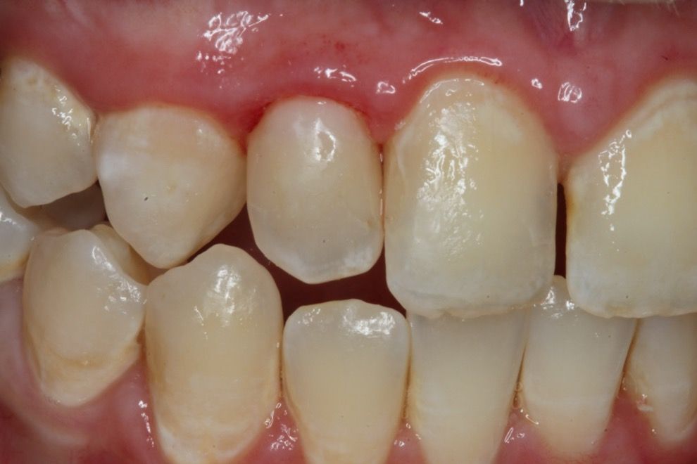 How to Manage Patients With High Caries Risk Using Nonsurgical ...