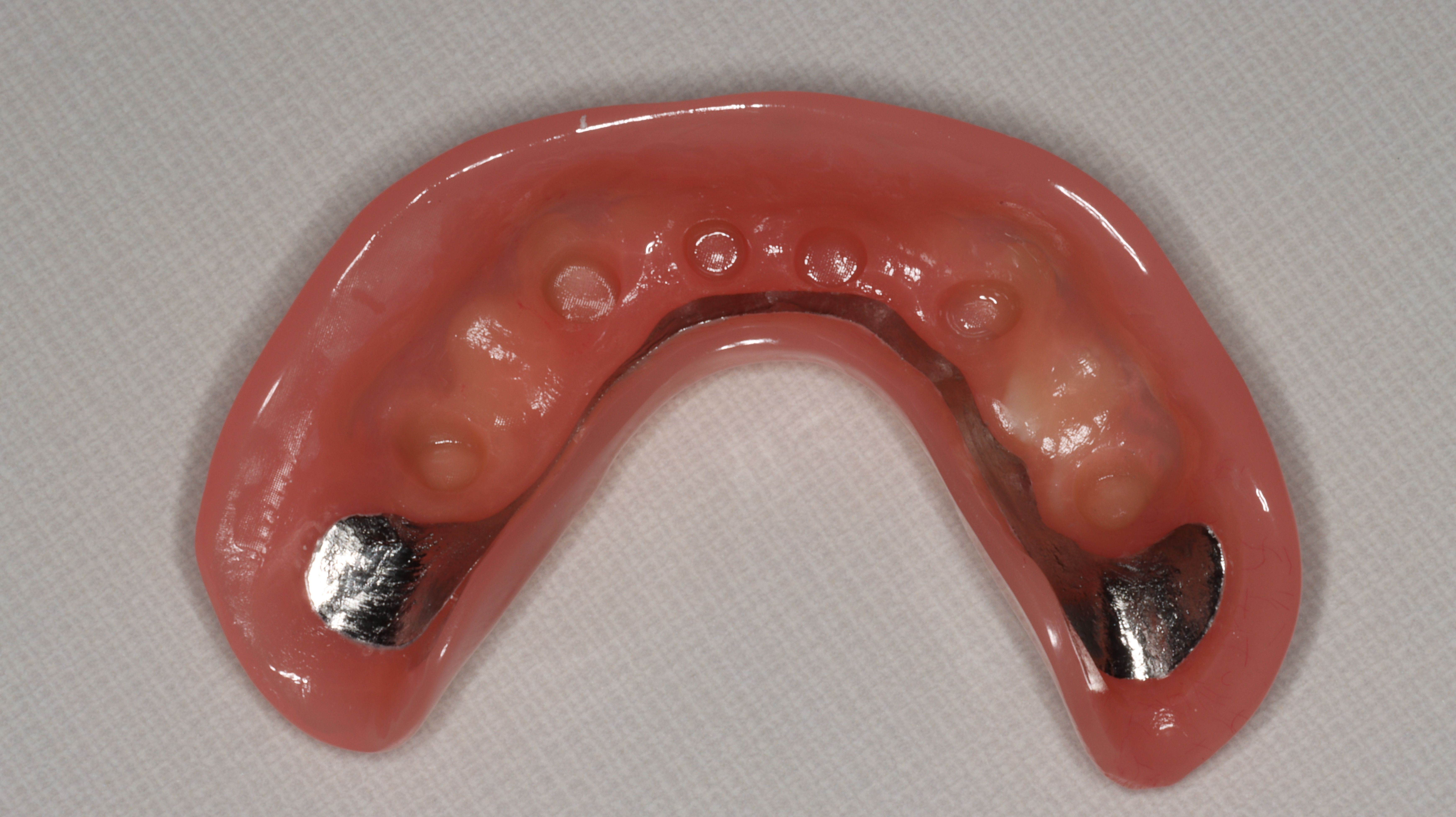 Figure 19. Intaglio side of overdenture with cast metal reinforcement.