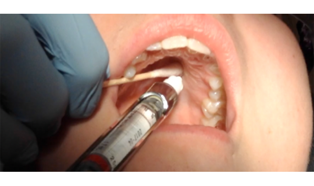 The Anterior Middle Superior Alveolar (AMSA) Nerve Block