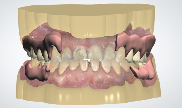 digital techniques for creating partial dentures