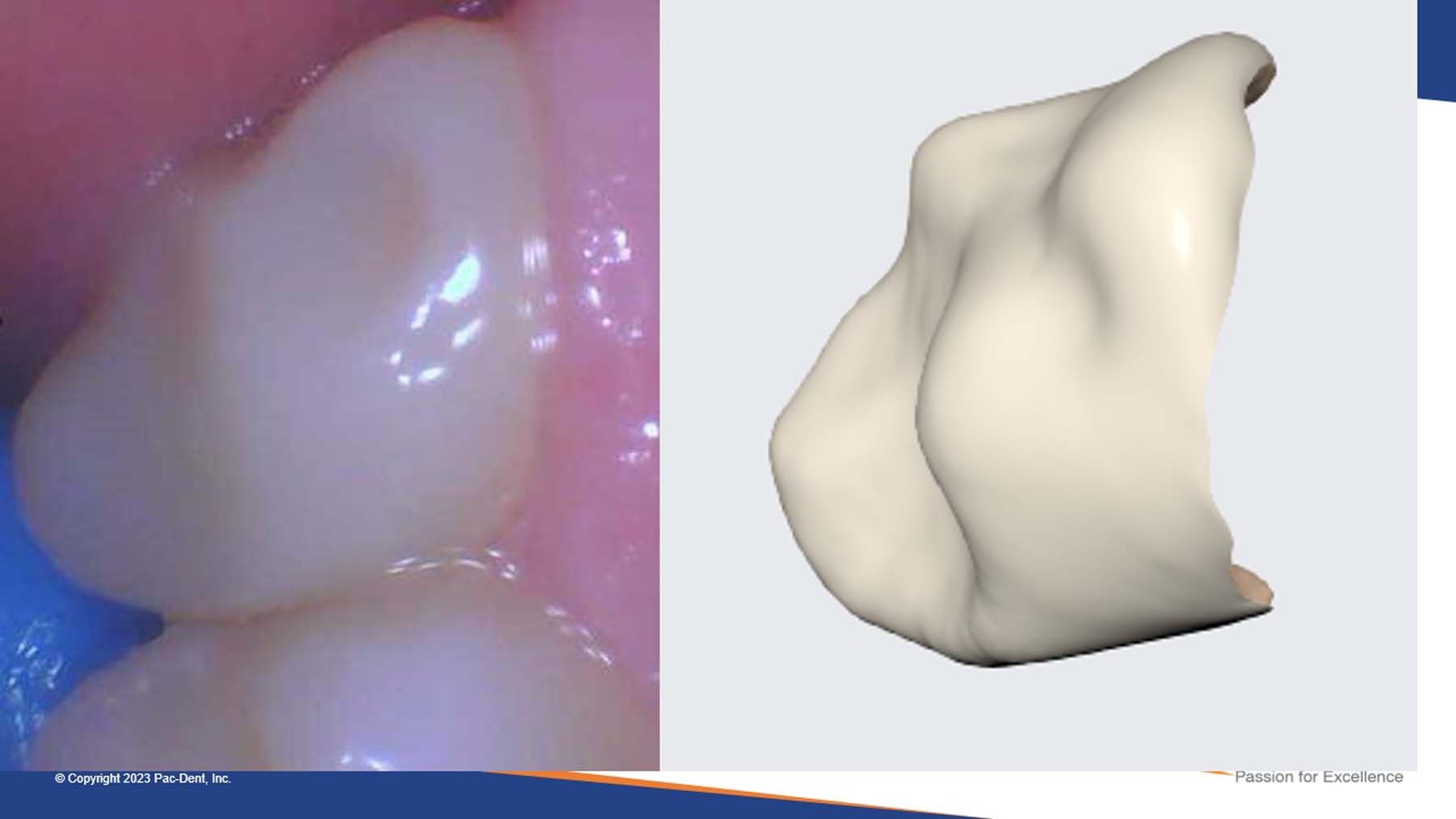Figures 3a and 3b. Durable and resilient: the restorations showed no color or shade changes months later, and the surrounding tissues remained healthy.