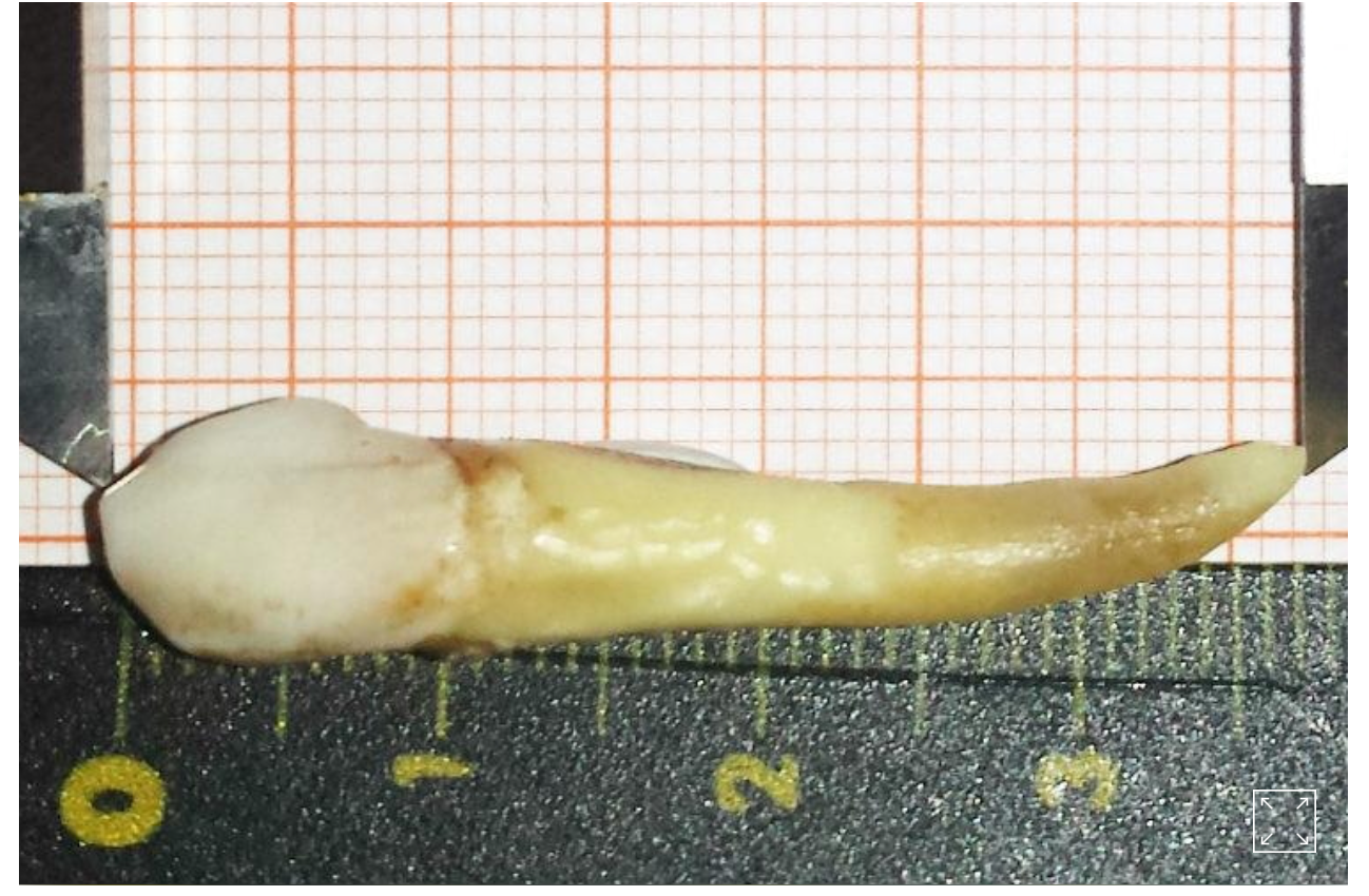 Longest extracted tooth