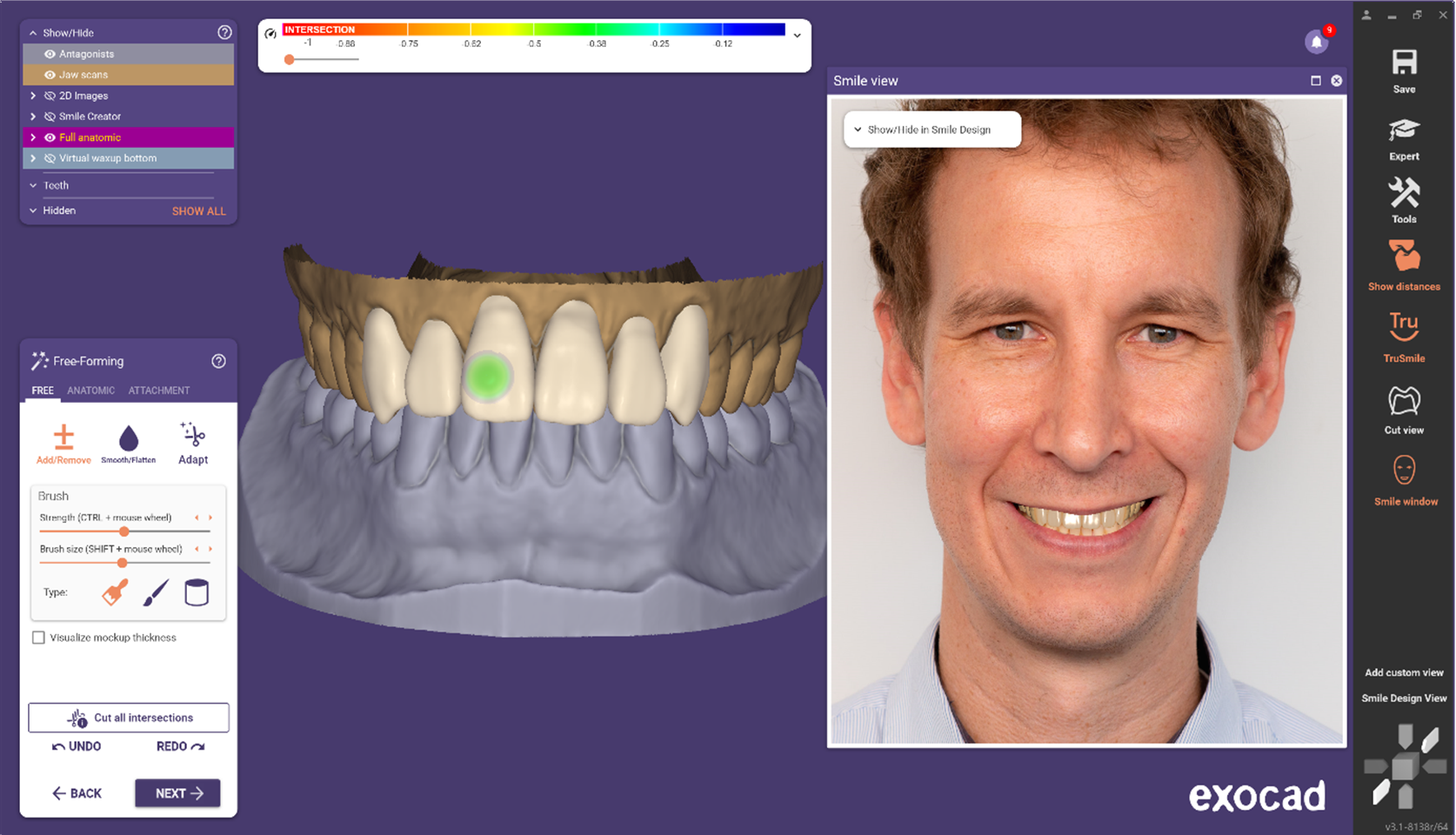 Advanced restoration design features in ChairsideCAD from exocad | image © exocad