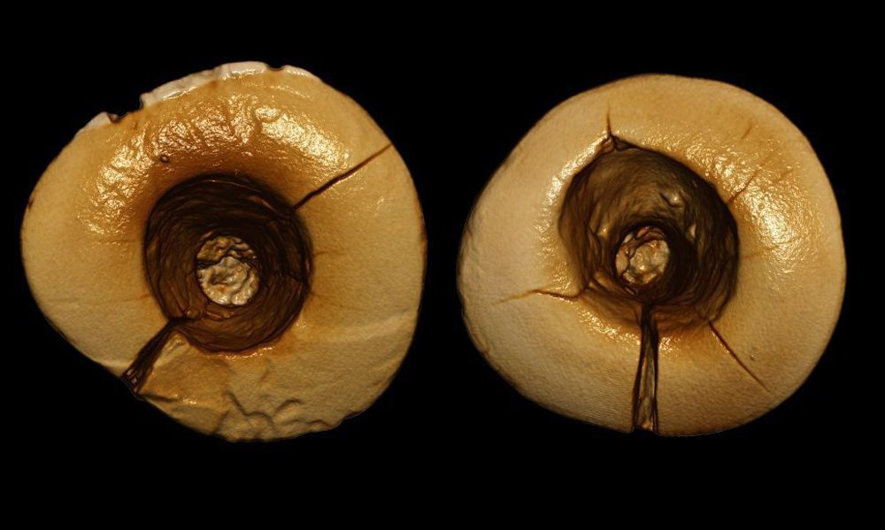 History of Dental Filling Materials From Prehistoric to ModernTimes