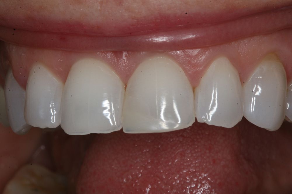 Match Tooth Shade Post Bleaching: Following Up With Restorative Cases