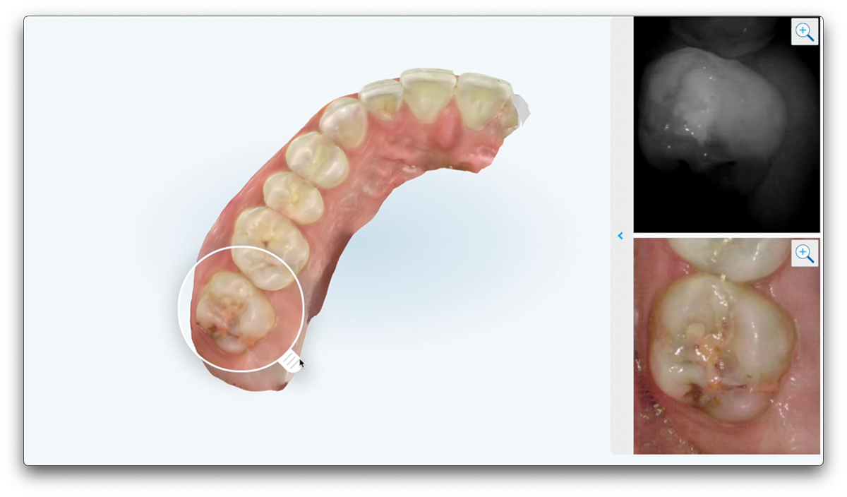 The Changing Face of Chairside Engagement intraoral scanning caries detection