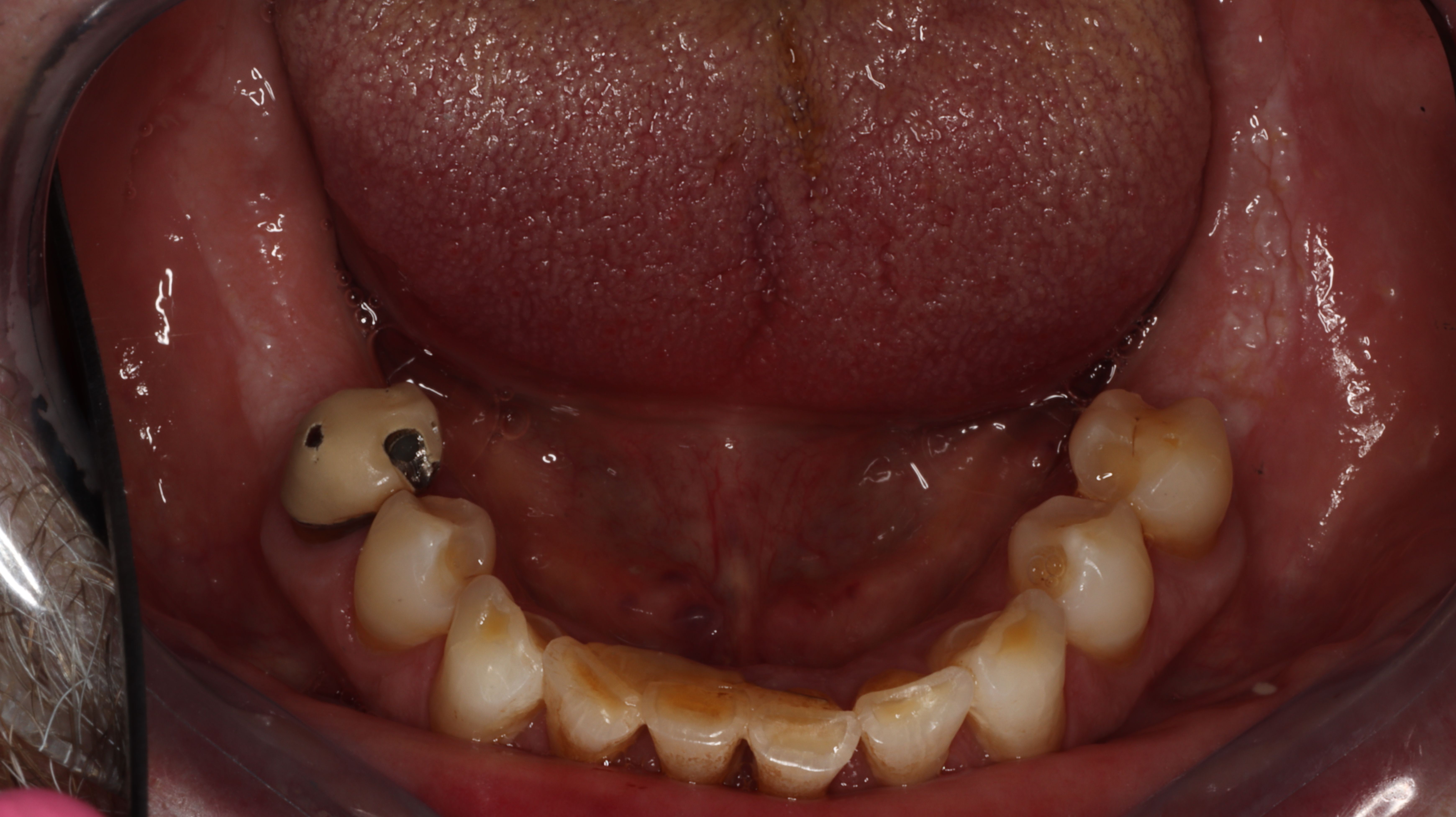 Figure 2. Occlusal view pre-op extraction of periodontally-involved mandibular incisors.