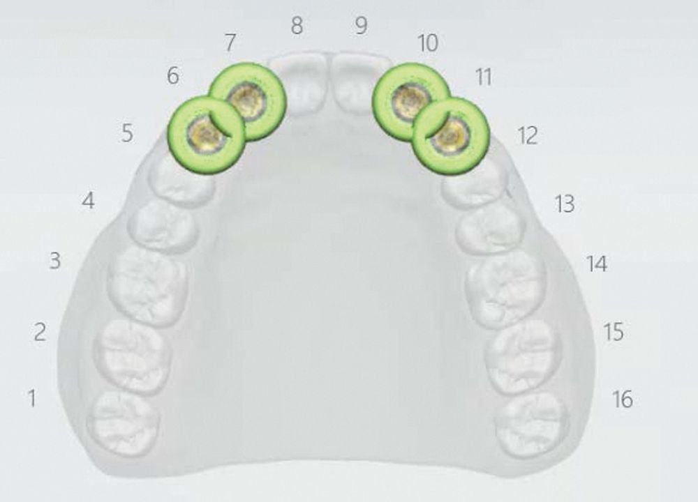 Merging of the 3D images allowed for proper implant planning and the printing of a surgical guide