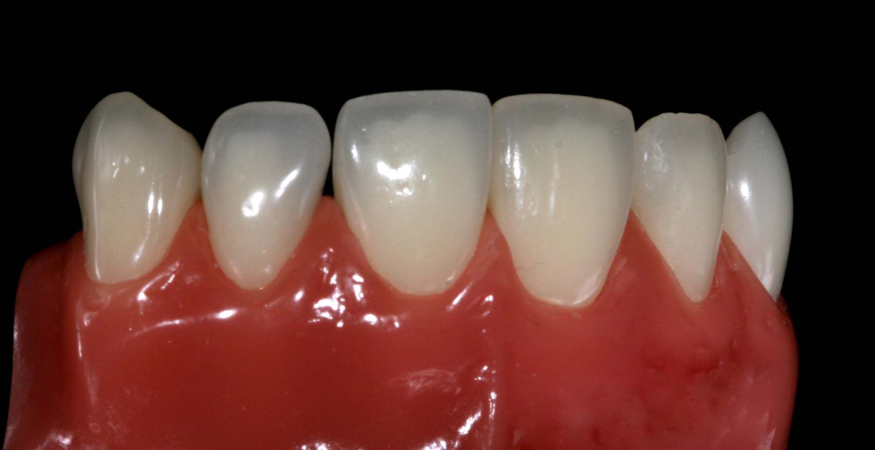 Figures 18. Final polish with OptraGloss lateral view Clinical photos: Courtesy of Frank J. Milnar, DDS