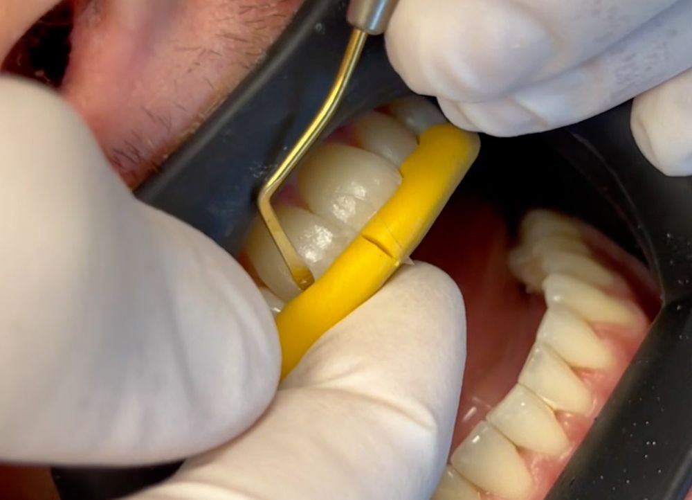 The Next Generation in Dental Composite Warming Technology