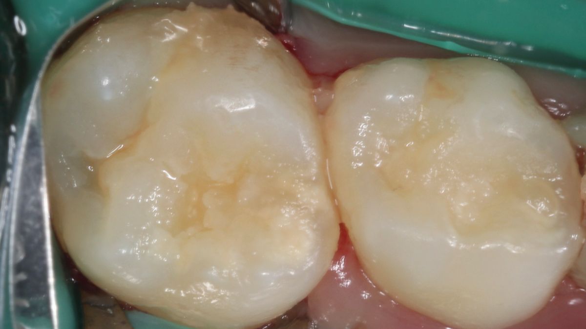 Case 1 Figure 1 8-year-old patient presents with tooth 16 with a smaller carious lesion that bordered between a protective resin restoration and a class I restoration