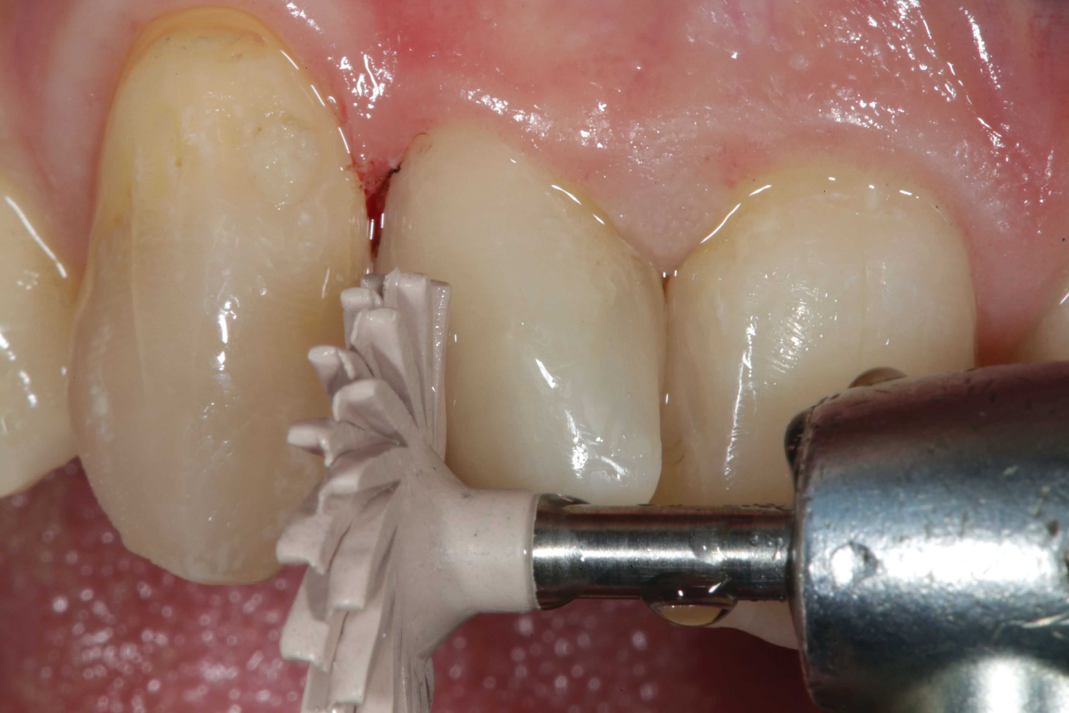 Estelite Bulk Fill Flow how to article