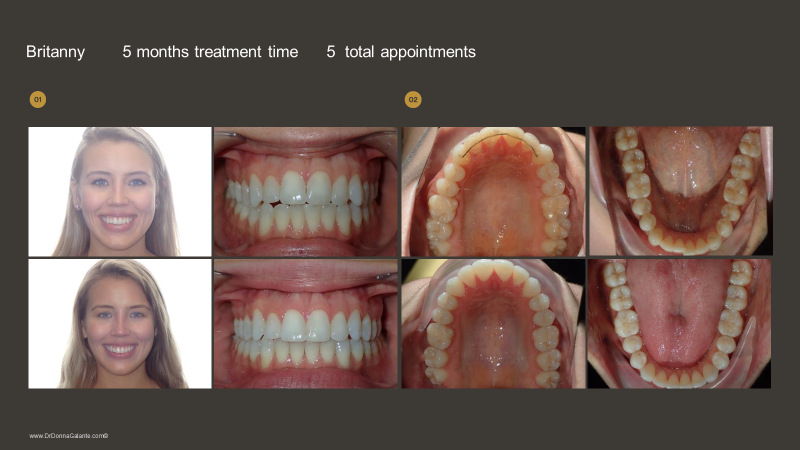 How to enhance the orthodontic experience with Propel VPro