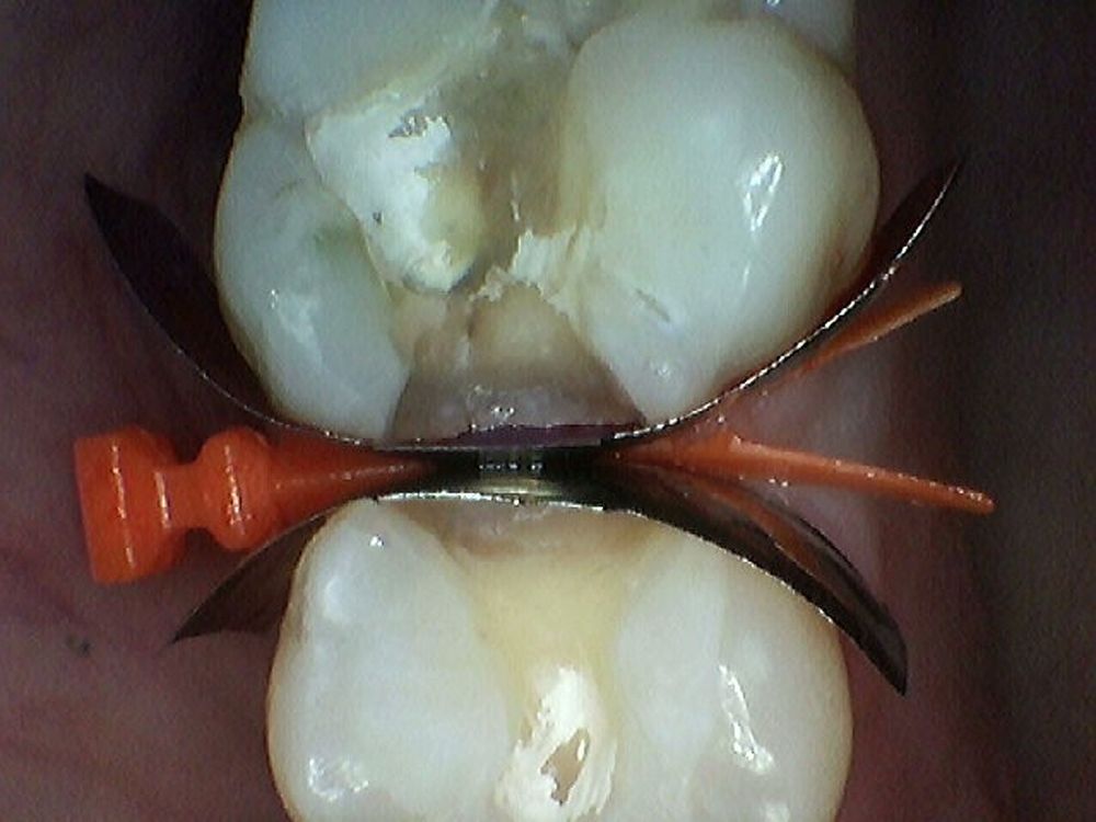 How to Overcome the Hurdles of Restoring Adjacent Class II Composites