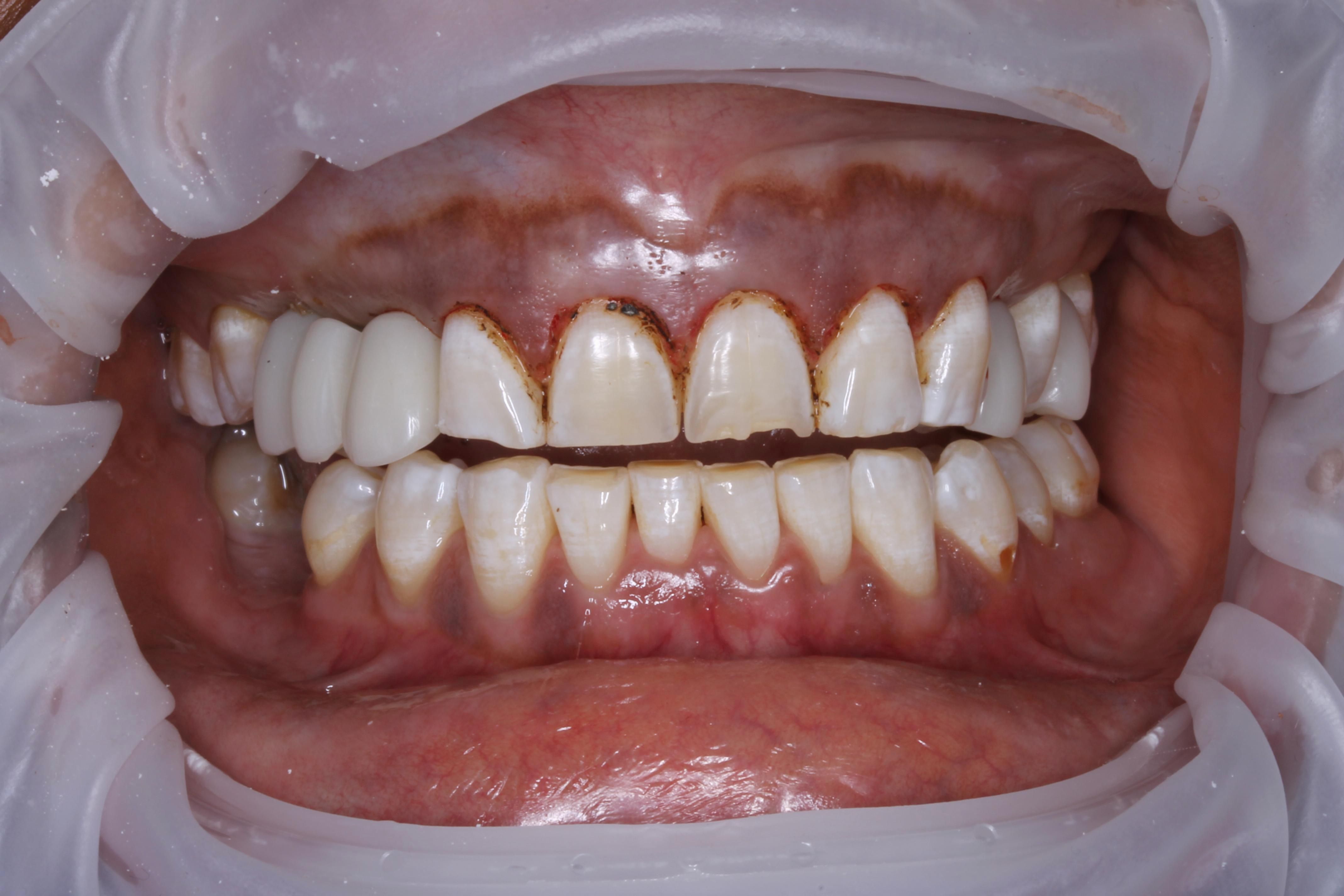 Figure 4. The temporary crowns as placed on the patient’s remaining posterior tooth.