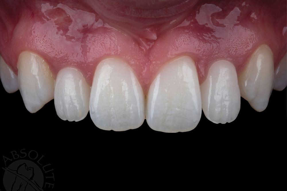 Conrad Fig.1 Monolithic high strength multi-layer zirconia #'s 7 & 10