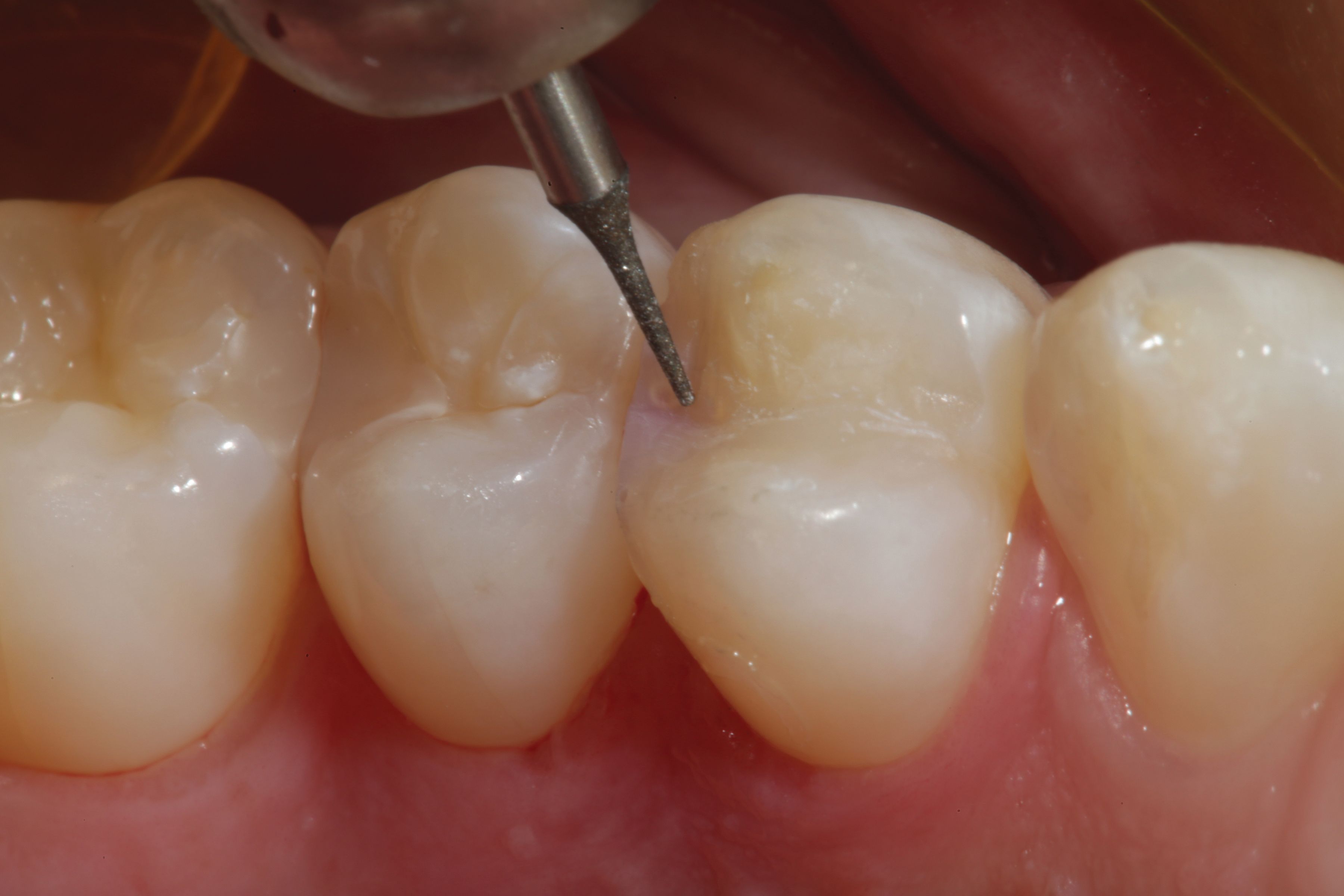Flowable Composite Process Flowable Composite Procedure at Tina Lown blog