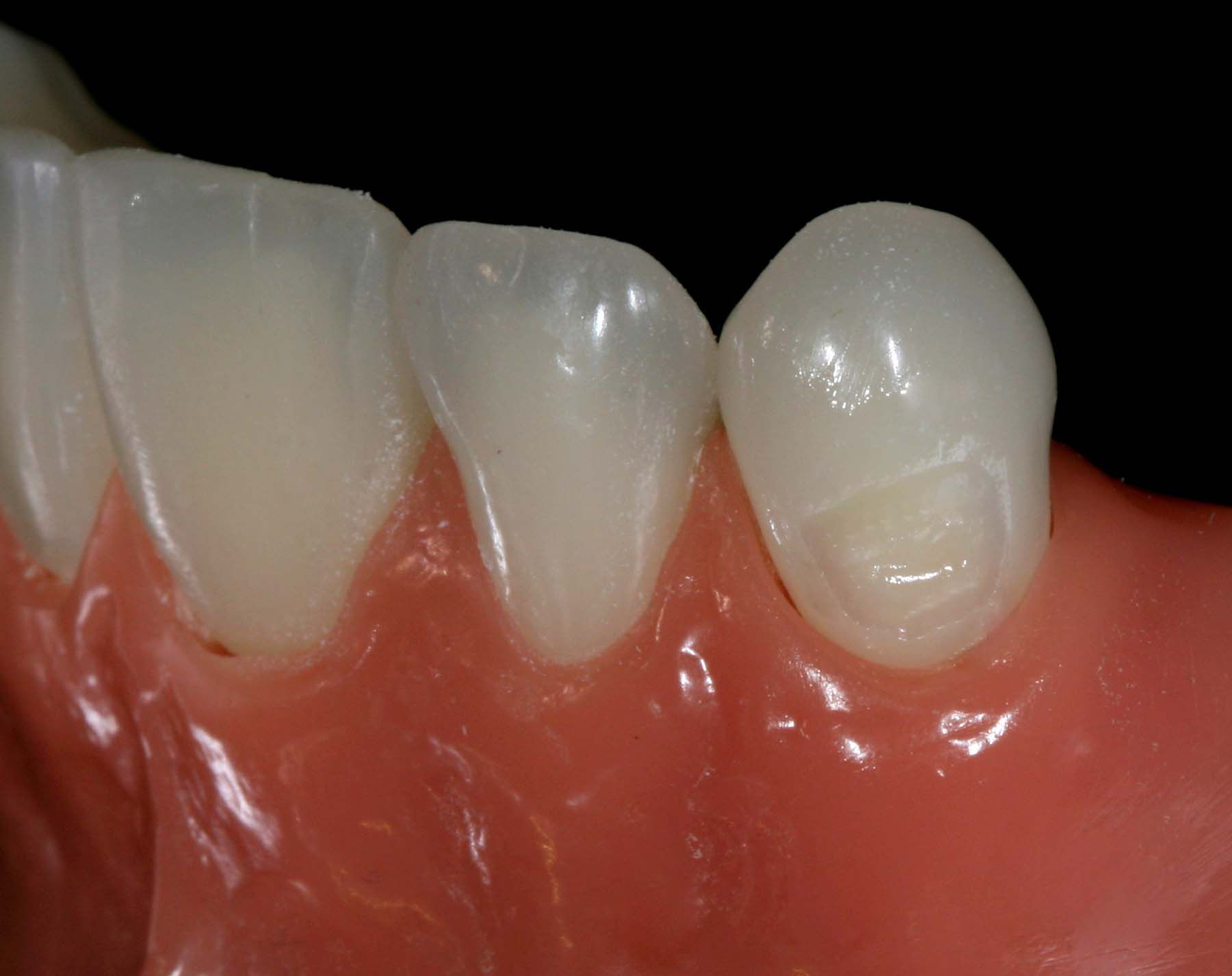 Figure 5. Adhesion placement light cured