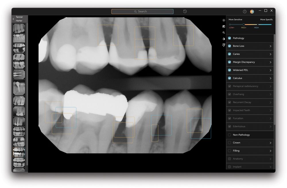 Second Opinion AI caries detection from Pearl
