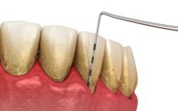 Periodontitis is Not Diagnosed by Probing Depths Alone