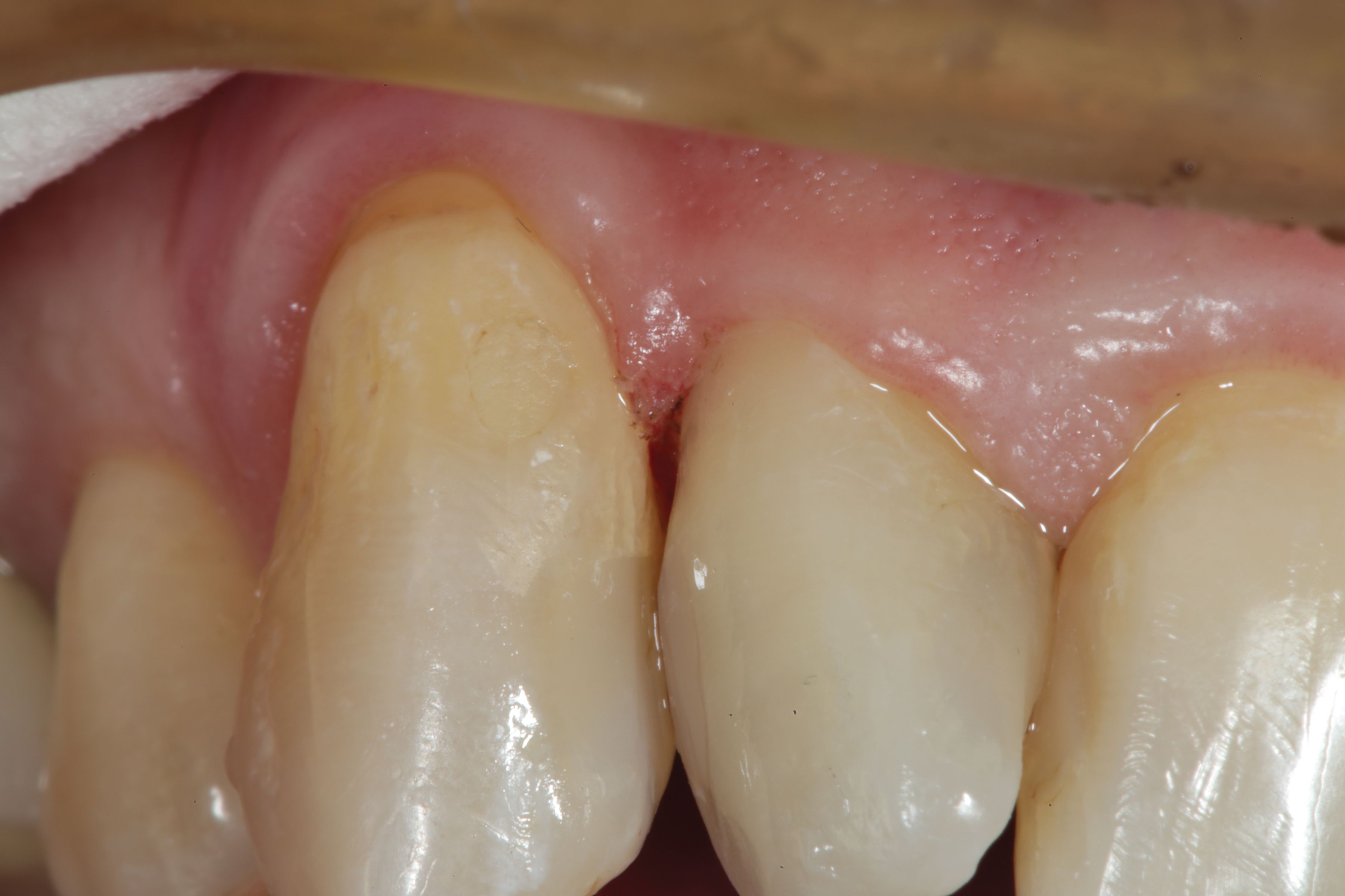Flowable Composite Process How to Bulk Fill Flowable Composite Restorations Without a Capping Layer