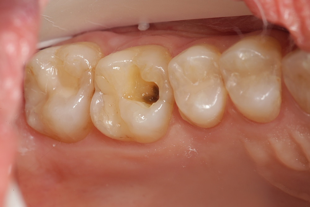 Decay is visible following removal of a defective restoration. A bioactive restorative material will be used to prevent future recurrent decay in the same restored tooth. 