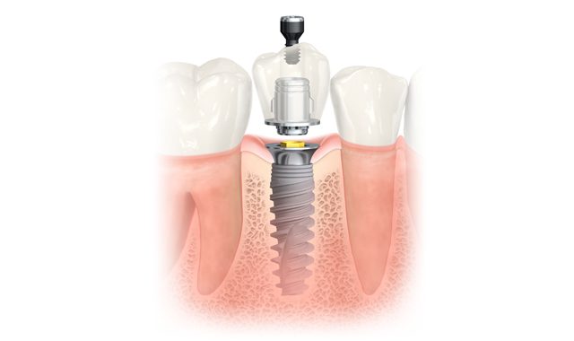 Nobel Biocare Unveils New Implant Material Software Solutions Dental Products Report