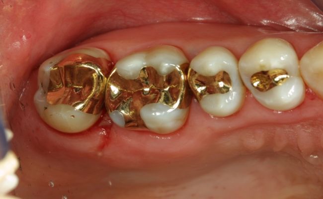 Gold dental fillings
