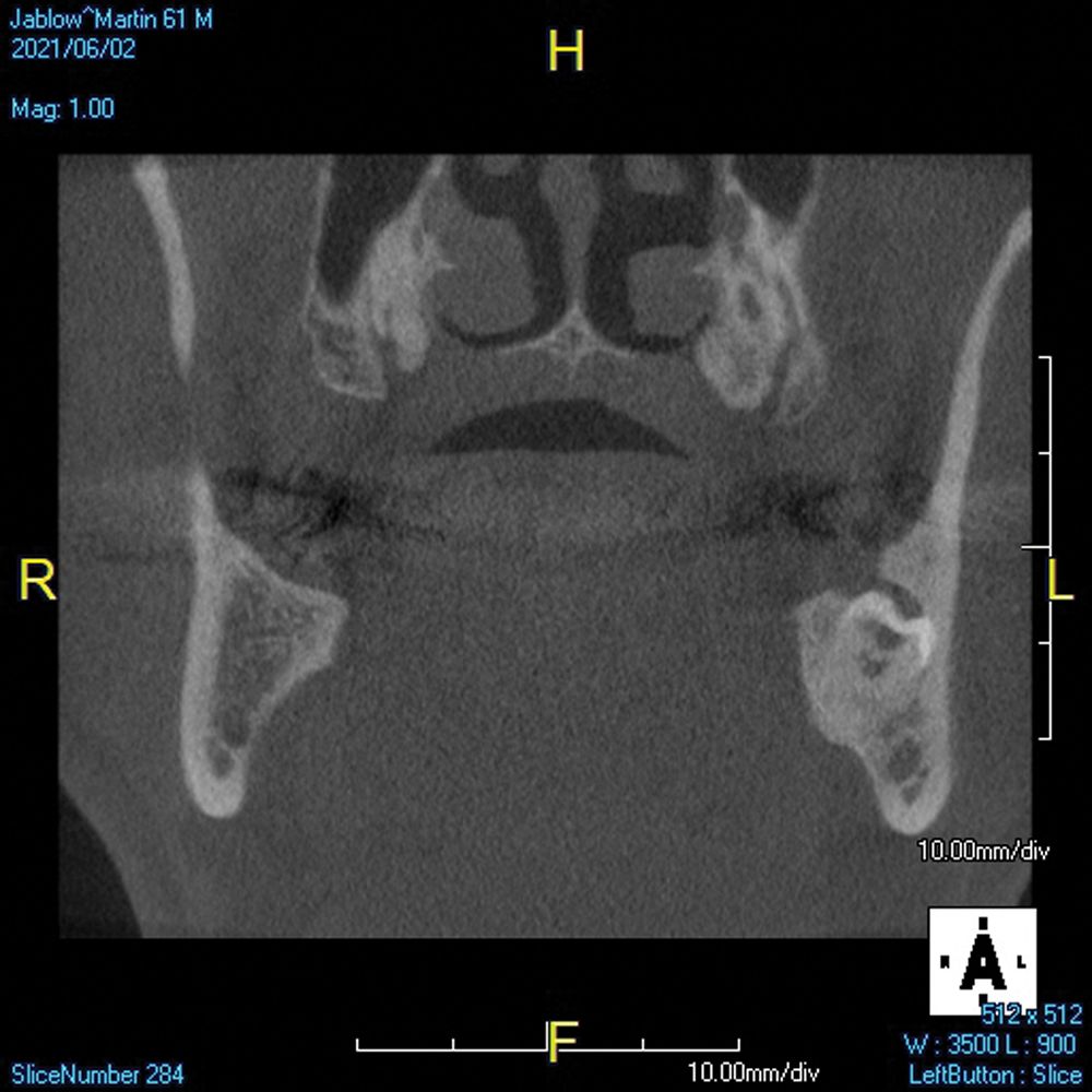 Impacted third molars are another scenario in which CBCT imaging gives you necessary data.2 Knowing how close the teeth are to the inferior alveolar nerve can make a better surgical approach possible and hopefully minimize trauma to the area and reduce the likelihood of a paresthesia