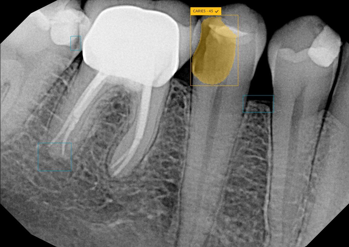 DEXIS DTX Studio Clinic AI 2D dental findings | ©Envista