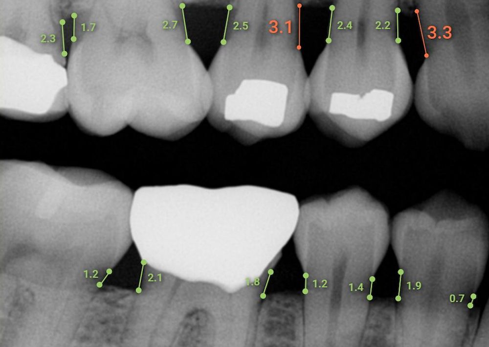 Overjet Dental Assist