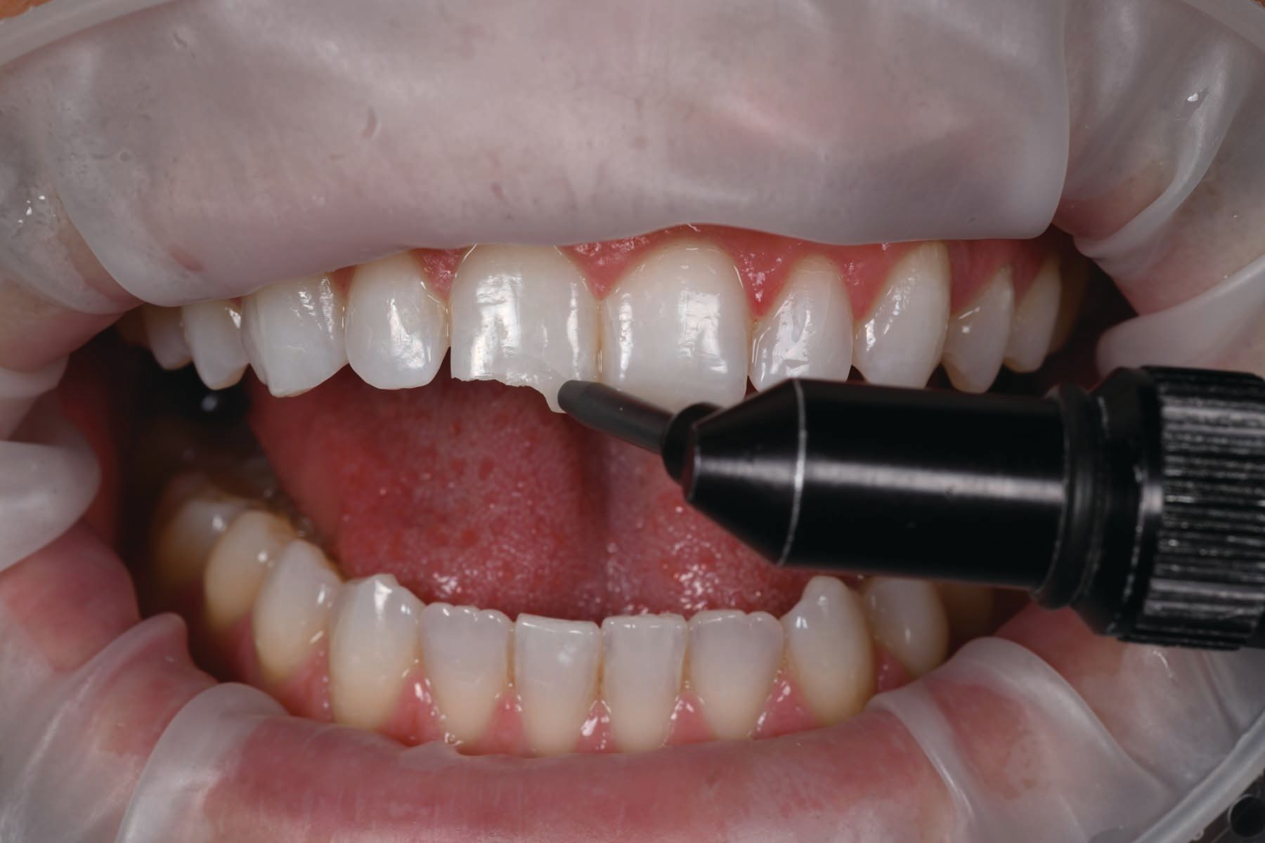 Figures 5 and 6. The fractured surfaces of the tooth were cleaned and air abraded to ensure a strong bond of composite to enamel and dentin.