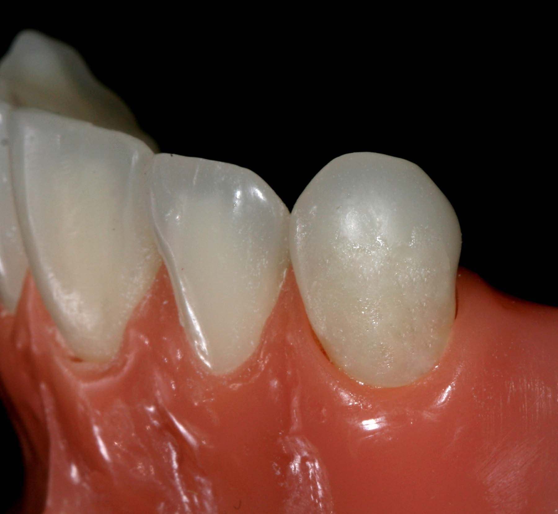 Figure 13. OMNICHROMA final contoured layer light cured