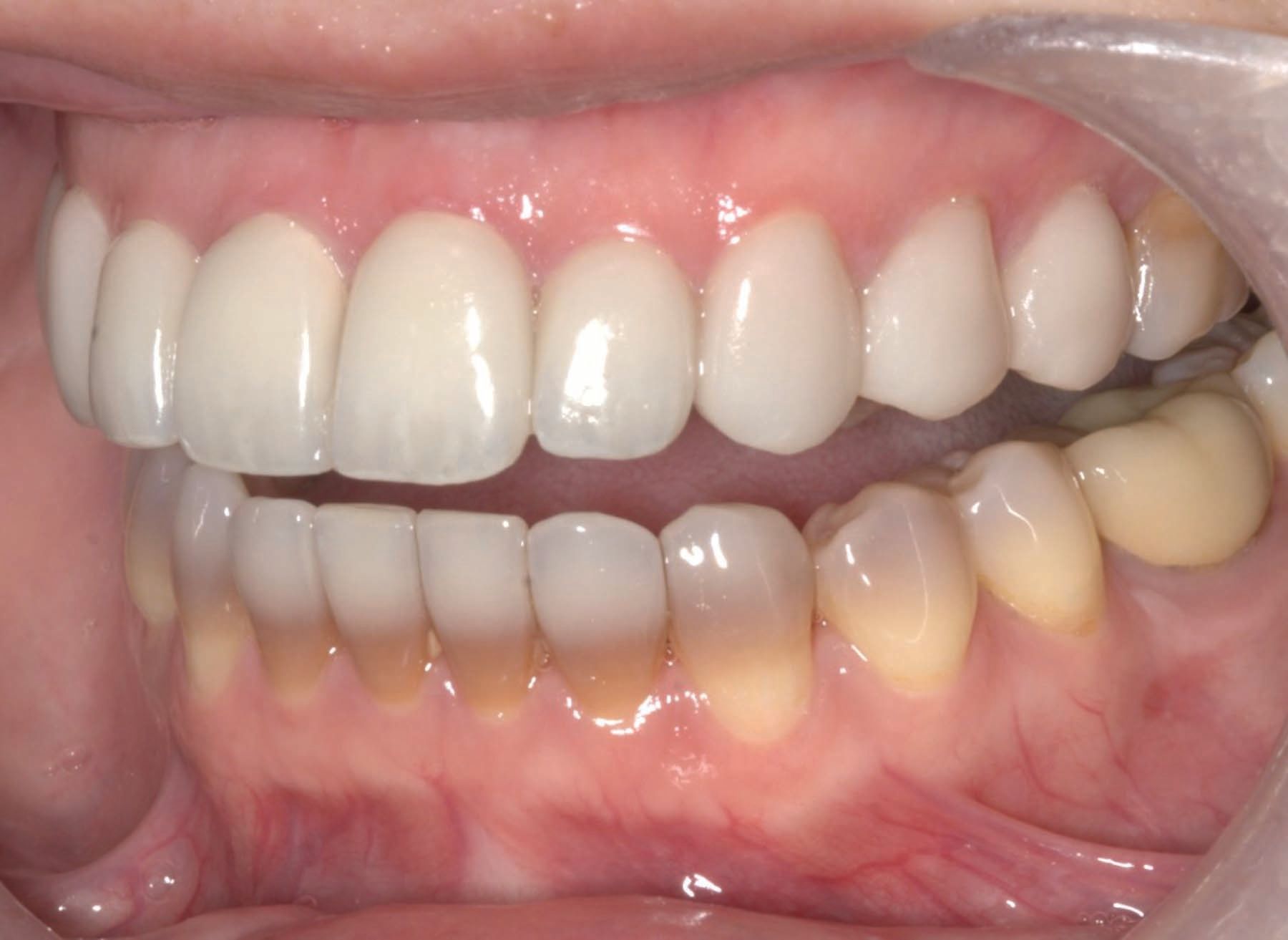 Figure 24. Postoperative 1:2 image of retracted left lateral teeth. 