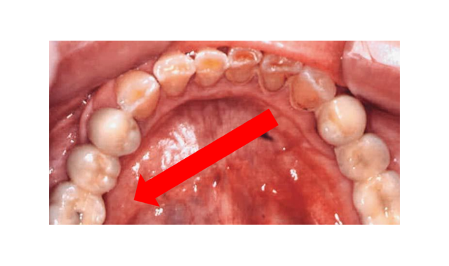 Mylohyoid Nerve Block