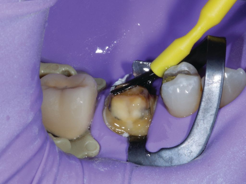 Figure 5: All-Bond Universal is scrubbed onto the prepped tooth in two 20-second intervals.