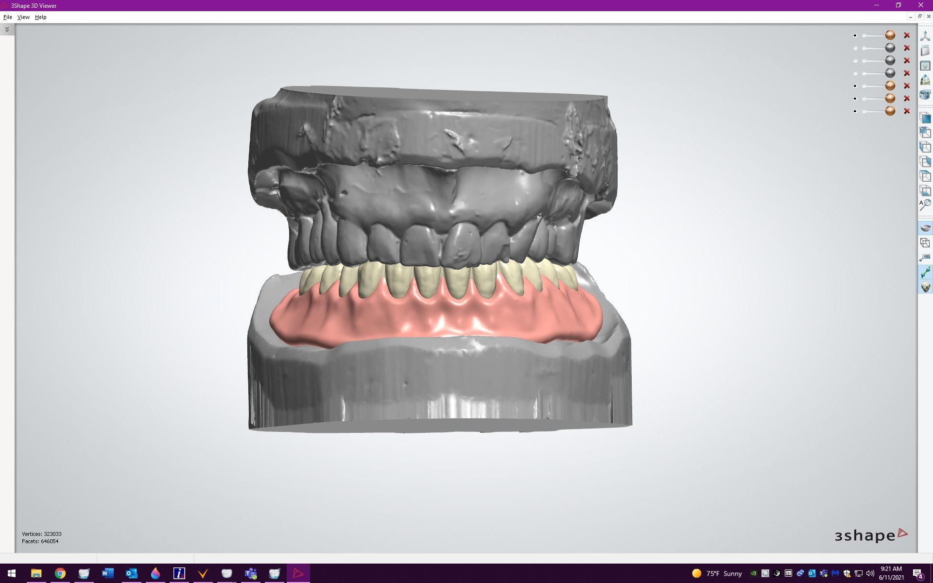 Figure 15. Digital setup for mandibular, cast bar reinforced, overdenture.