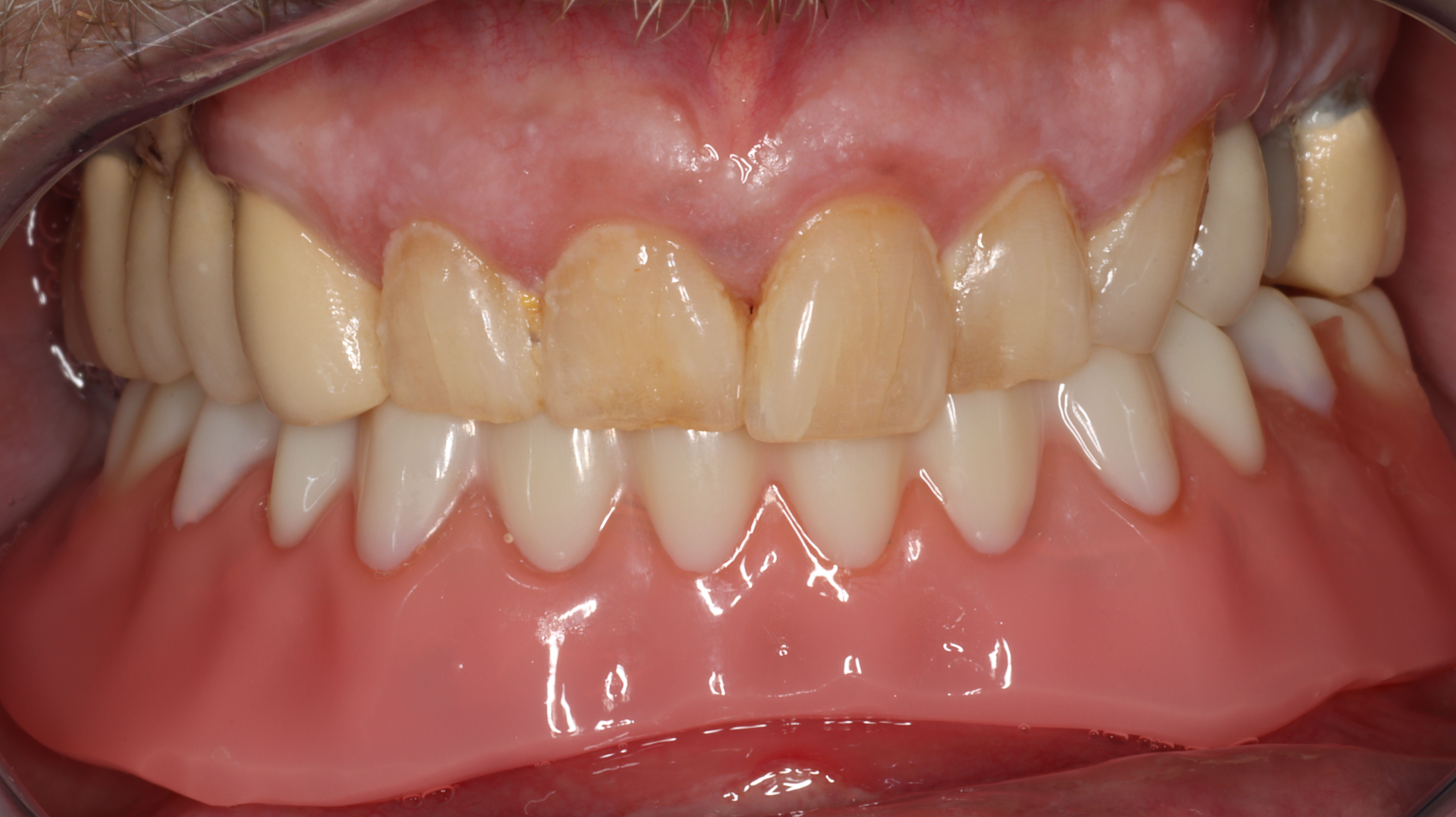 Figure 23. Denture seated, occlusion verified at the completion of surgery and restorative pickup of attachments.