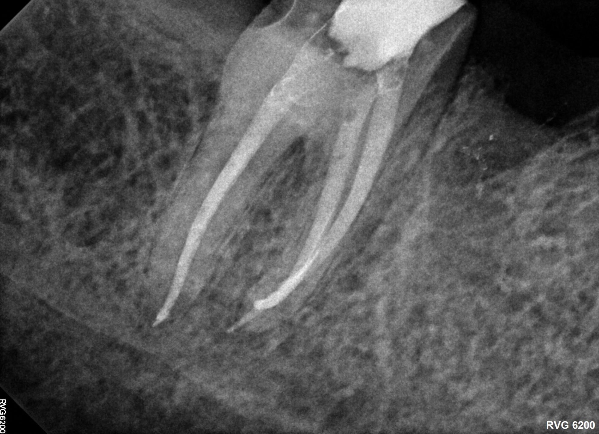 Vital Pulp Therapy in Mature Permanent Teeth: A Paradigm Shift