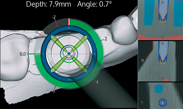 Applying The X Guide Dynamic 3d Navigation System In Your Practice Applying The X Guide Dynamic 3d Navigation System In Your Practice