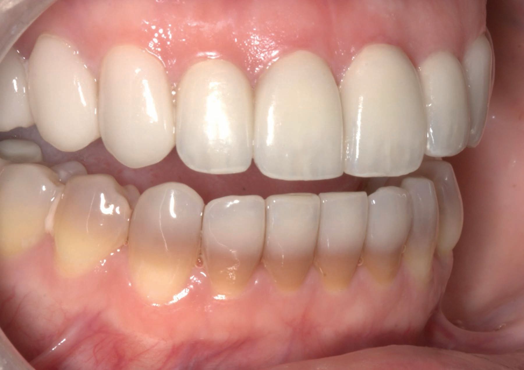 Figure 23. Postoperative 1:2 image of retracted right lateral teeth. 