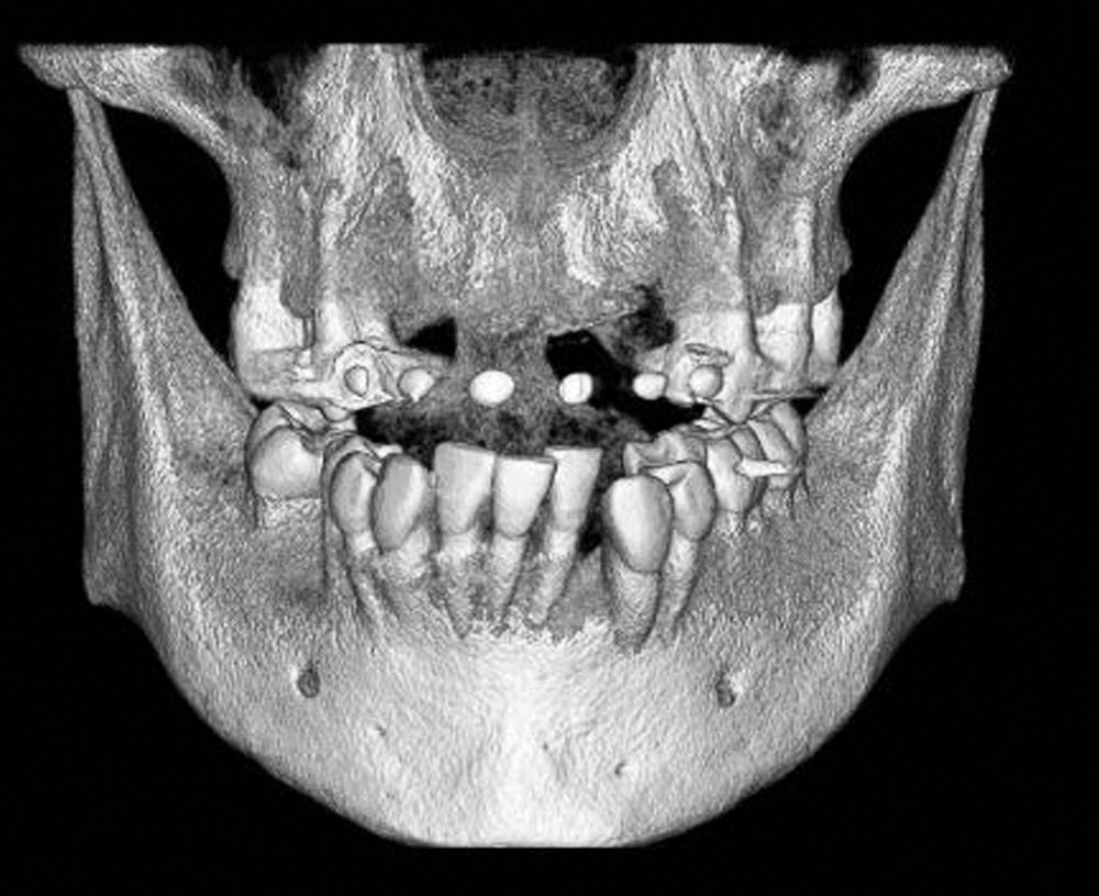 After sufficient healing, the RPD was used as a guide by placing flowable composite on the front teeth. The RPD was placed in the mouth again, and the CBCT scan was taken for additional planning