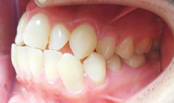 How to increase predictability for faster tooth movement