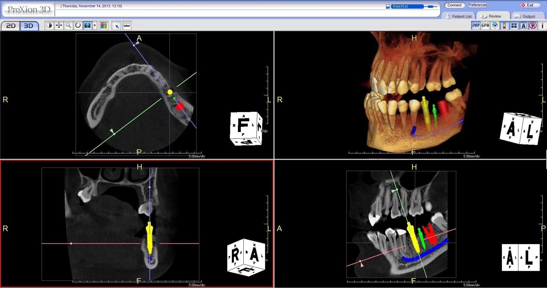 Scans captured with the PreXion Excelsior CBCT system | Image © Marty Jablow, DMD