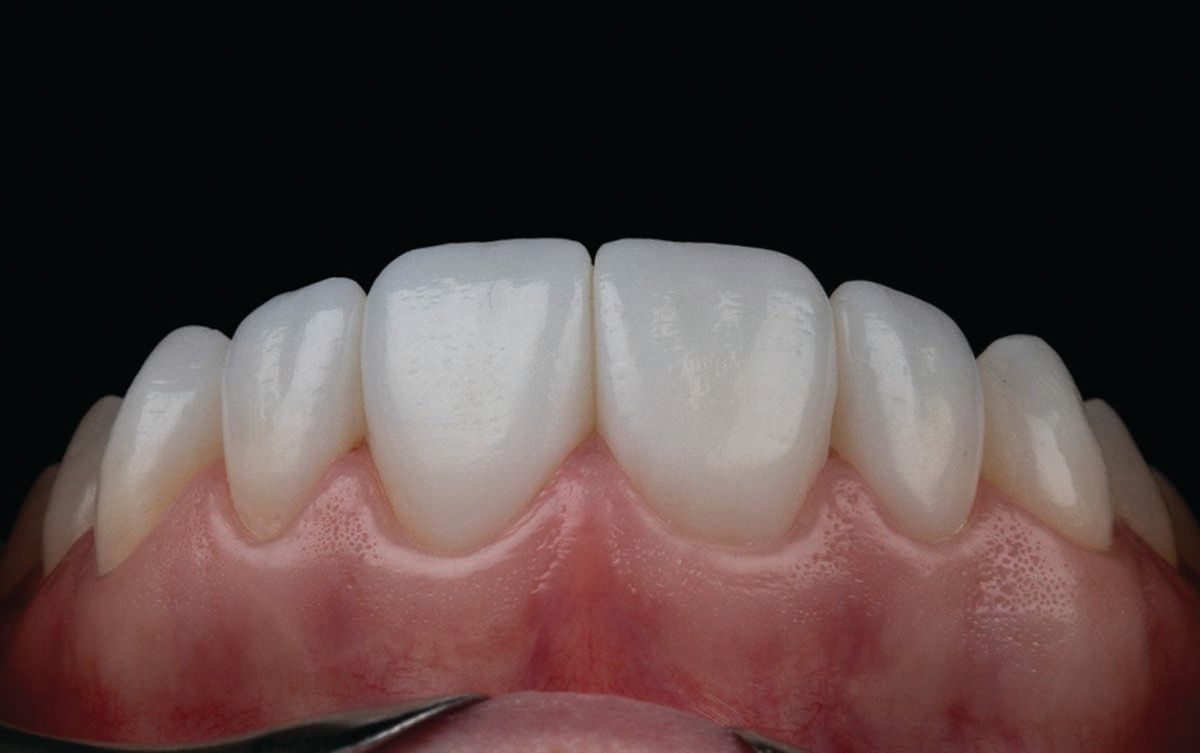 Figures 1 and 2. Before-and-after photos of patient treated with SmileFast (After image is shown above). | Image Credit: © SmileFast 