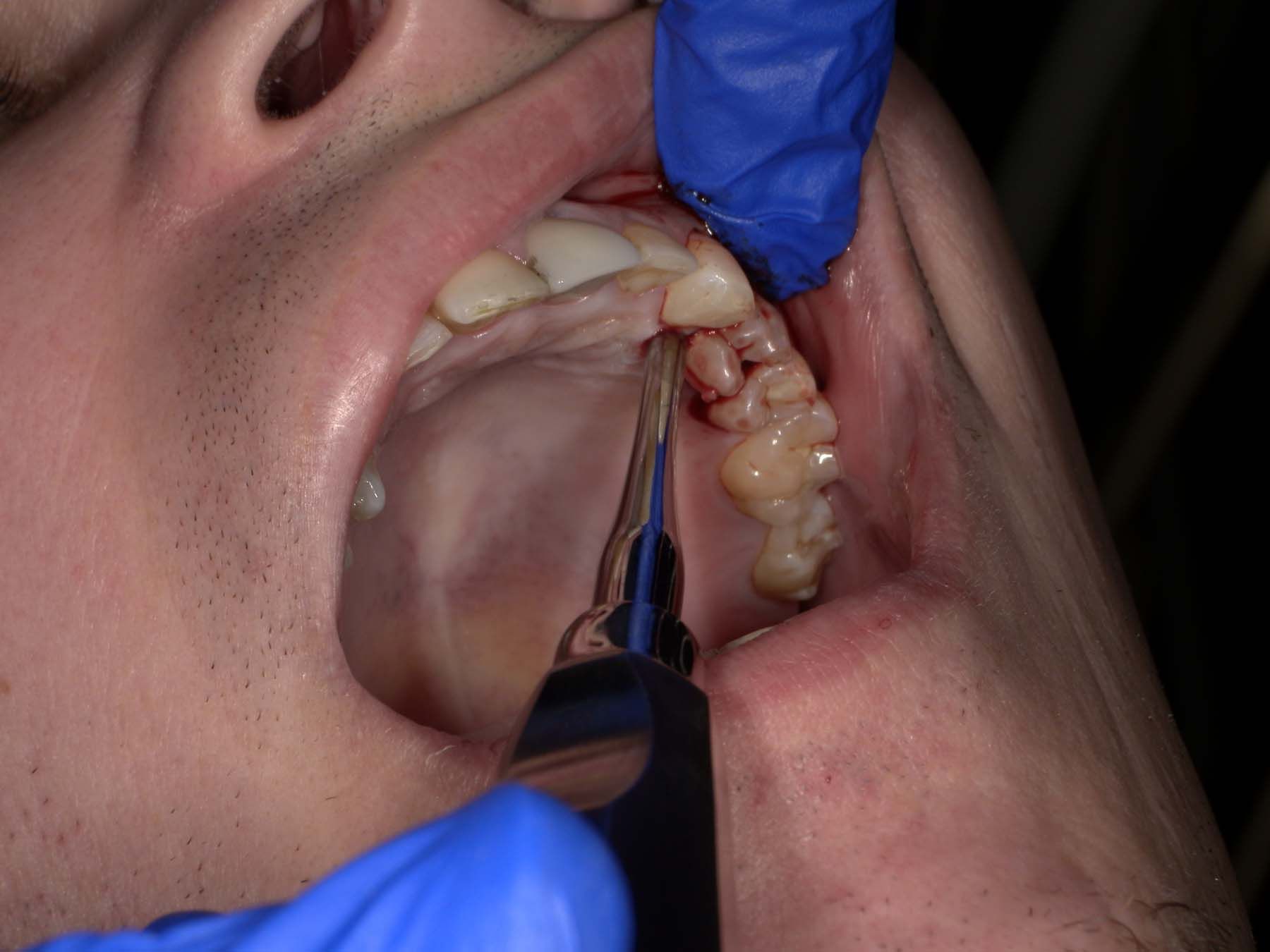 Figure 4. Inserting a 301 surgical elevator into the embrasure on the nondecayed mesial of the tooth.