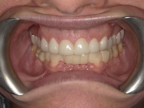 The patient returned with severe occlusal wear on teeth 23-26 that had extended to the pulp. | Ankur Gupta, DDS